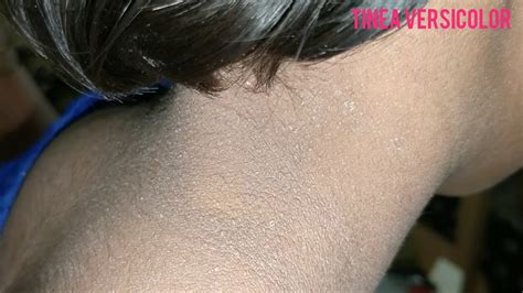 Tinea Versicolor In A Young On The Neck Youtube