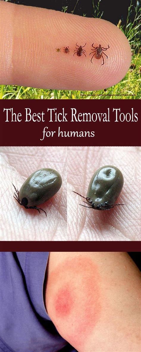 How To Remove A Tick From A Human How To Do Thing