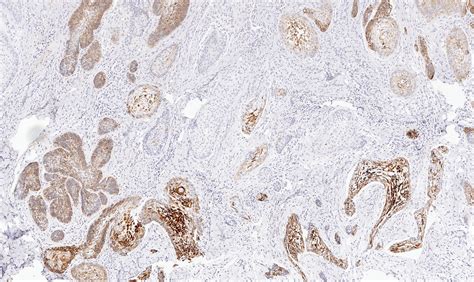 Peripheral Ameloblastoma Presenting As A Pyogenic Granuloma A Case