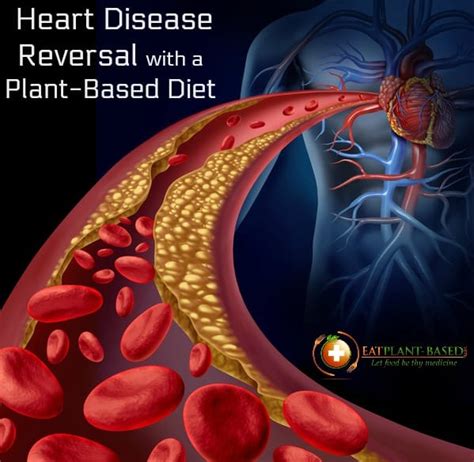 Only Diet Proven To Reverse Heart Disease Eatplant Based