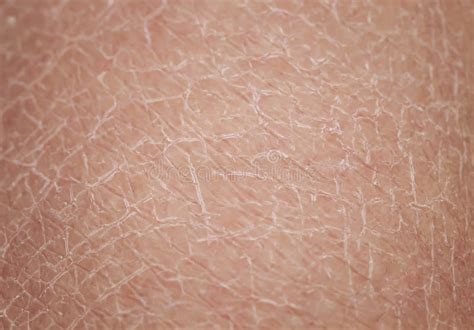 Texture Of Human Skin Large With Dermatological Problems Of Dryness And
