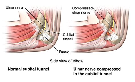 Cubital Tunnel Syndrome Cedars Sinai