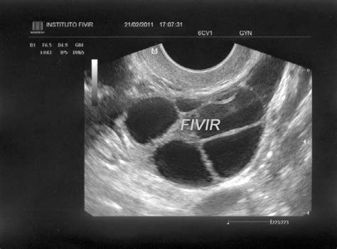 Ovários Com Padrão Multifolicular