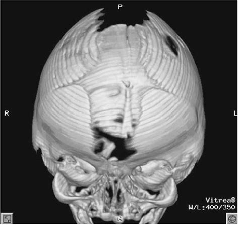 D Ct Image Depicting The Midline Calvaria Defect In Apert Skull And