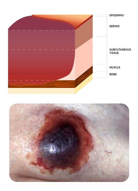 Wound Types Pressure Injuries And Ulcerations Sexiz Pix