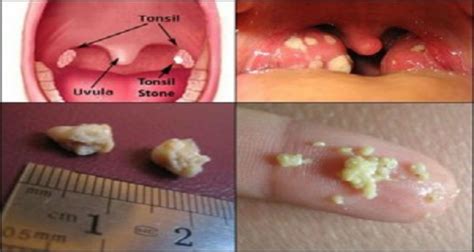 Get Rid Of Tonsil Stones Naturally Without Surgery Health Tip