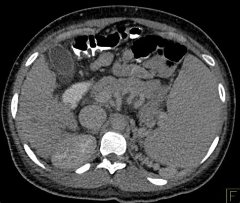 Foxman b, klemstine kl, brown pd. Acute Pyelonephritis in a Pregnant Patient - Kidney Case ...