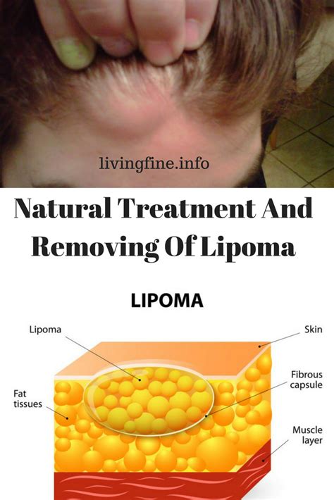 Natural Treatment And Removing Of Lipoma