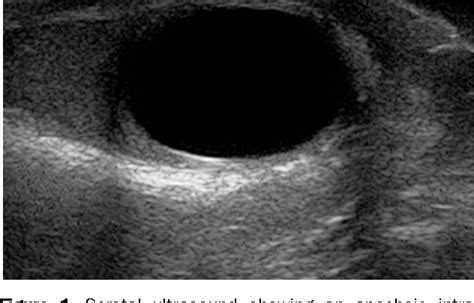 Testicular Cyst Ultrasound