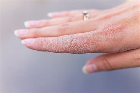 5 Immediate Fixes For Dry Hands Neutrogena®