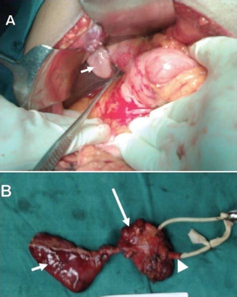 Intraoperative View Of The Lesion A With A Collapsed Open I