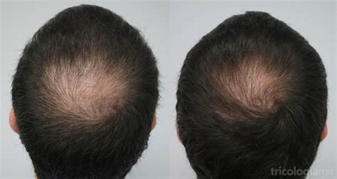 Mesoterapia De Dutasteride Para Alopecia Androgenética En Coronilla