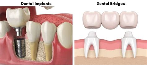 Dental Implants Are They Really Worth The Money The Dental Studio