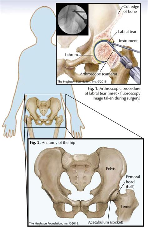 Hip Arthroscopy Hughston Clinic