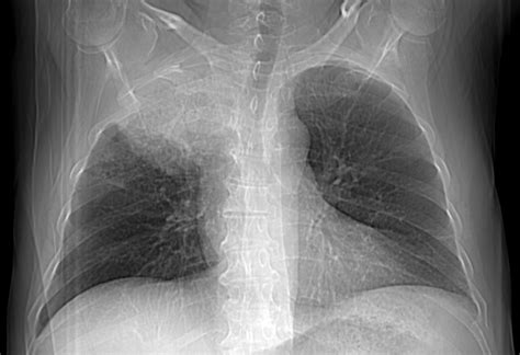 Fungal Pneumonia In An Immunocompromised Patient Image