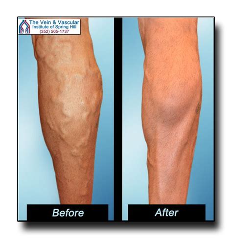 Pin On Varicose Veins Before And After Pictures Spring Hill Florida