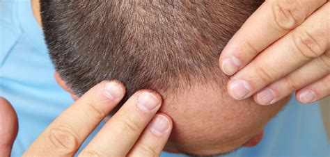Lo Que Necesitas Conocer Sobre La Alopecia Areata