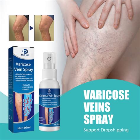 South Moon 30ml Varicose Veins Treatment Spray For Legs Smooth Blood