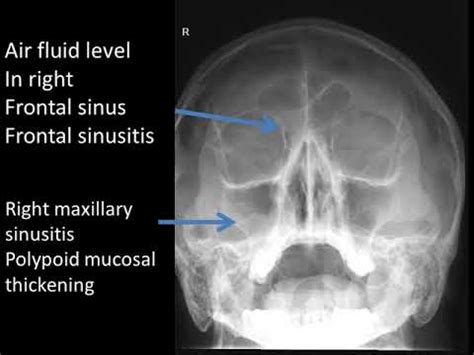 Maxillary Sinusitis X Ray