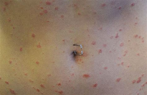Pityriasis Rosea Skin Rash Photograph By Cnriscience Photo Library Images