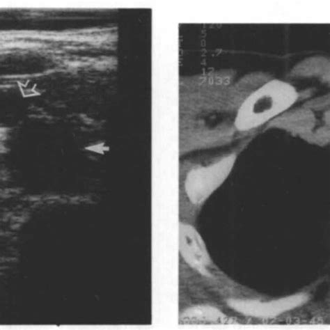 Axial Sonogram Of The Right Supraclavicular Fossa In A Patient With