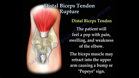 Distal Biceps Tendon Rupture Everything You Need To Know Dr Nabil