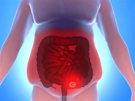 Rectal Cancer Rectal Cancer Warning Signs And Symptoms Causes Treatment And Prevention Tips