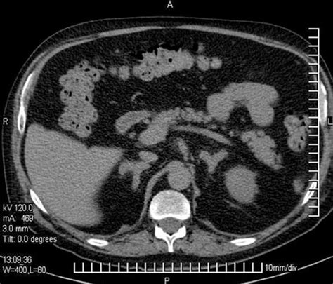 Abdominal Ct Scan Showing Diffuse Enlargement Hyperplasia