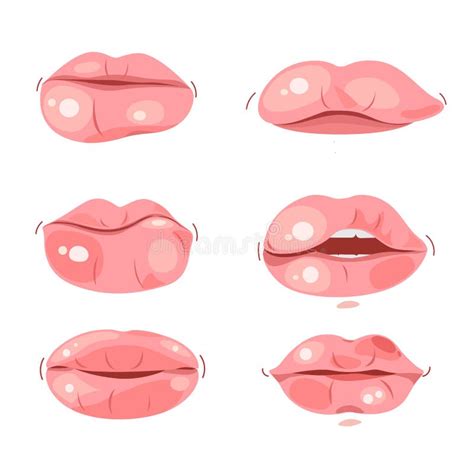 Swollen Lips Stock Vector Illustration Of Deficiencies 264863064