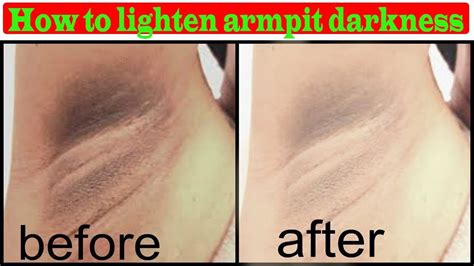 Ways To Get Rid Of You Armpit Darkness How To Lighten Armpit Darkness