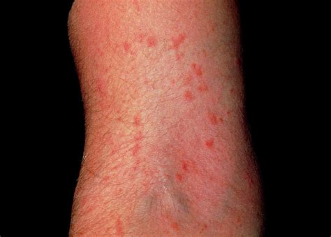 Scabies Infection On The Arm Photograph By Dr H C Robinson Science