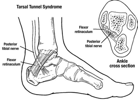 Tarsal Tunnel Syndrome Test Precision Medical Group