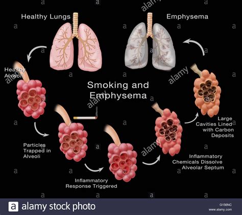 Stages Of Lung Damage Of A Smoker Leading To Emphysema The Illustration Cycles From The Top