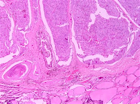 Pathology Outlines Parathyroid Adenoma