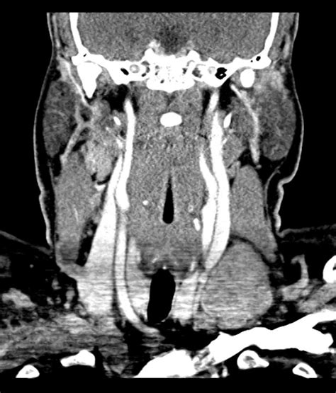 Cervical Lymph Nodes Radiology