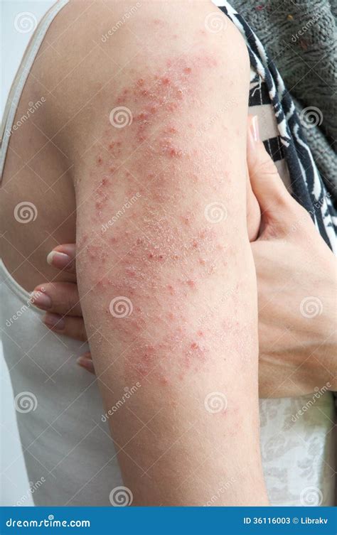 Allergic Rash Dermatitis Skin Royalty Free Stock Photography