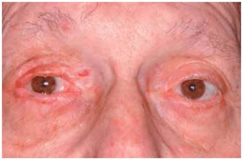 Eyelid Sebaceous Gland Tumors Ento Key