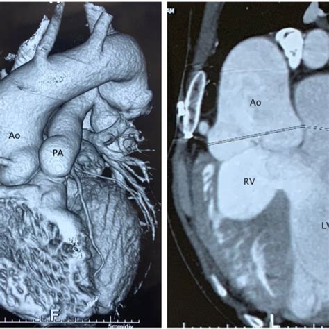 Computed Tomography View Showing Massively Dilated Ascending Aorta