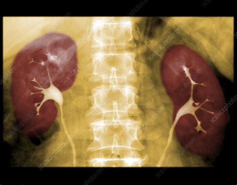 Ivp Of Normal Kidneys Stock Image F0312791 Science Photo Library