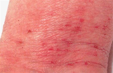 What Is Atopic Skin Disease