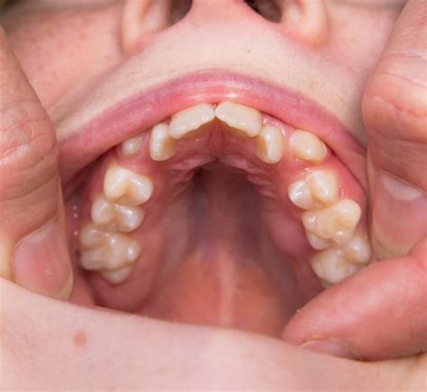 Thumb Sucking Treatment Natick Ma Oral Health Papageorgiou Dental Associates