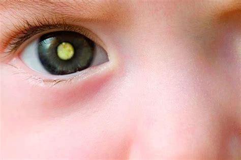 Cancer Nos Olhos Infantil