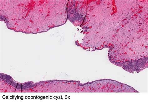 Pathology Outlines Calcifying Odontogenic Cyst