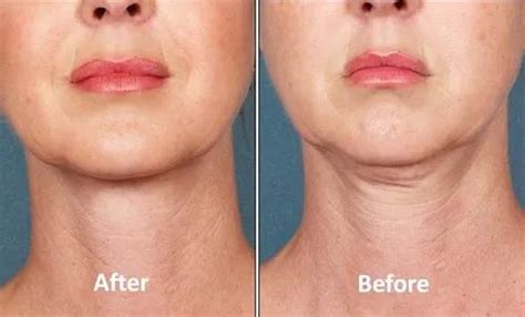 Get Rid Of Double Chin With Botox Treatment At Rs 20000box बोटॉक्स