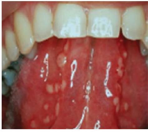 Figure 3 From Guidelines For Diagnosis And Treatment Of Recurrent Aphthous Stomatitis For Dental