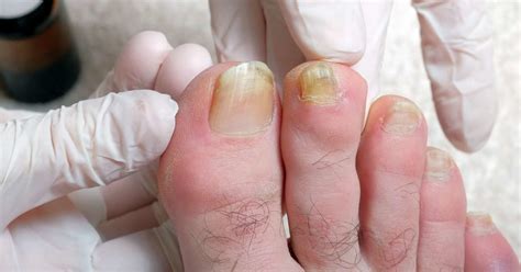 Why Are My Toenails Yellow Causes And Treatment