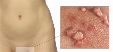 People who have ingrown hair issue can have sex, but those having herpes issue should avoid contact if they have symptoms. A Guide Of Things That Look Like Herpes But Aren't ...