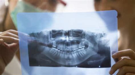 Understanding The Uses Of Panoramic X Rays In Oral Care