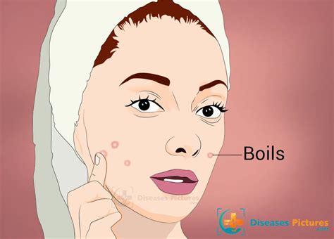 Boils Skin Abscess Symptoms Causes Treatment Prevention Healthmd