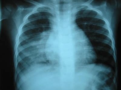 Usual interstitial pneumonia and chronic idiopathic interstitial pneumonia: Nanda Nic Noc: Diagnósticos nanda para neumonia.